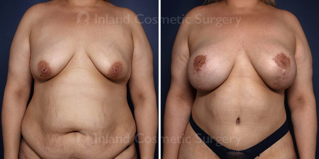 Breast Lift with Augmentation