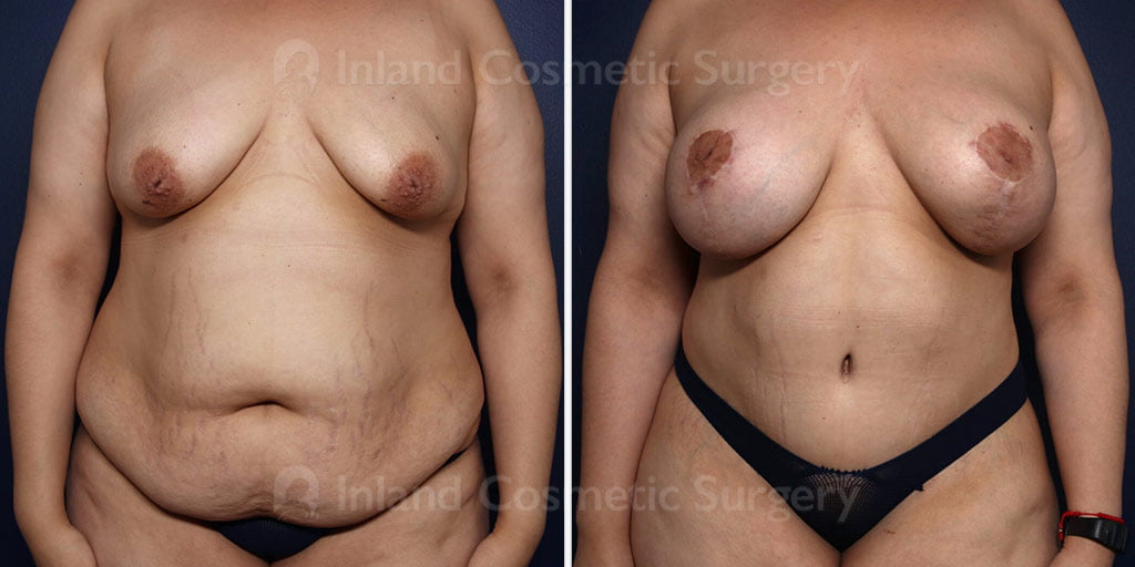 Tummy Tuck with Liposuction