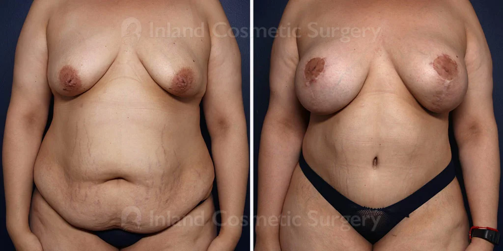 Tummy Tuck with Liposuction