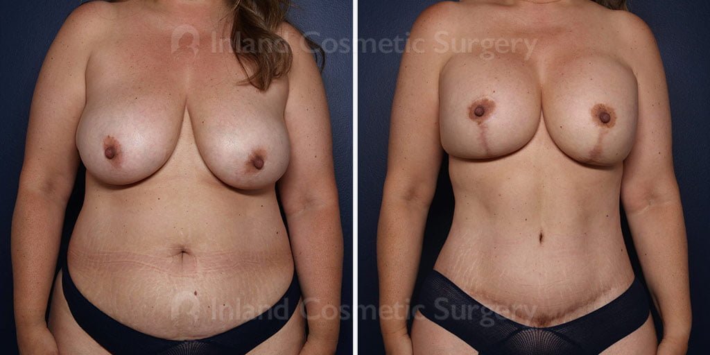 Breast Lift with Augmentation