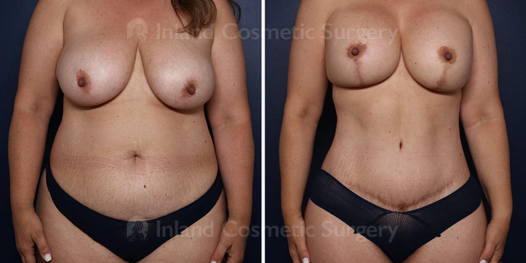 Tummy Tuck