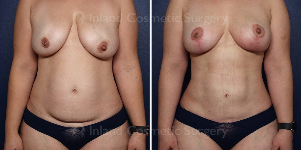 Mini Tummy Tuck