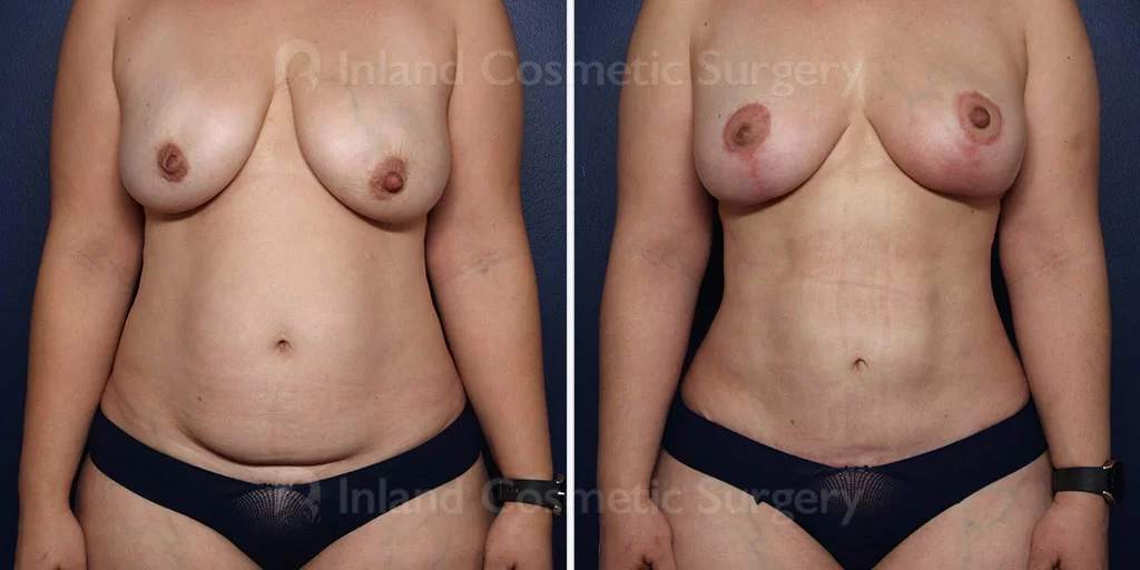 Mini Tummy Tuck