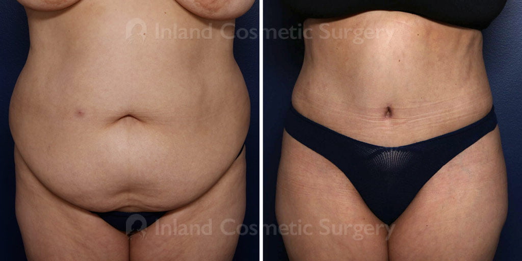Tummy Tuck with Liposuction