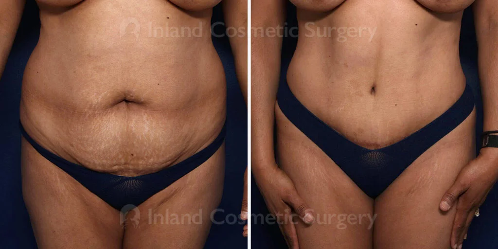 Tummy Tuck with Liposuction