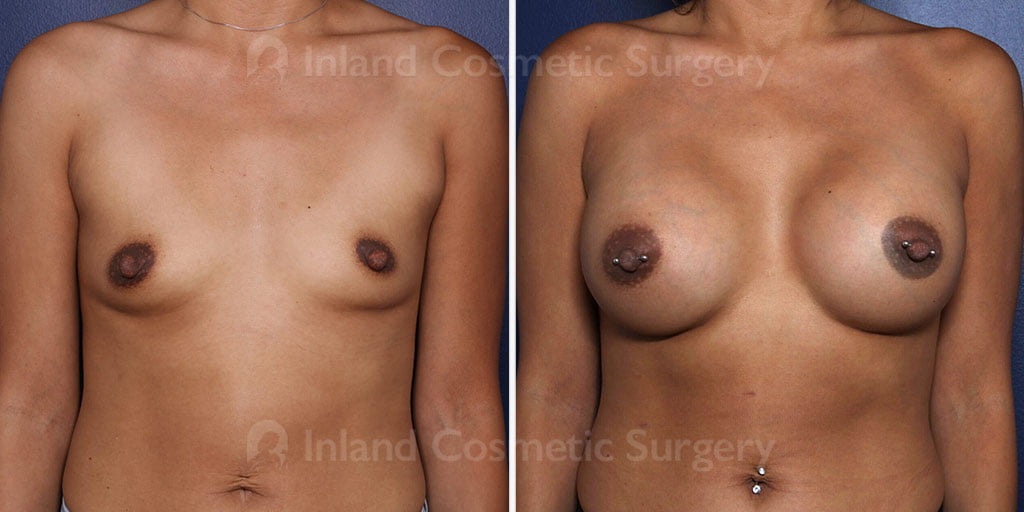 Breast Augmentation