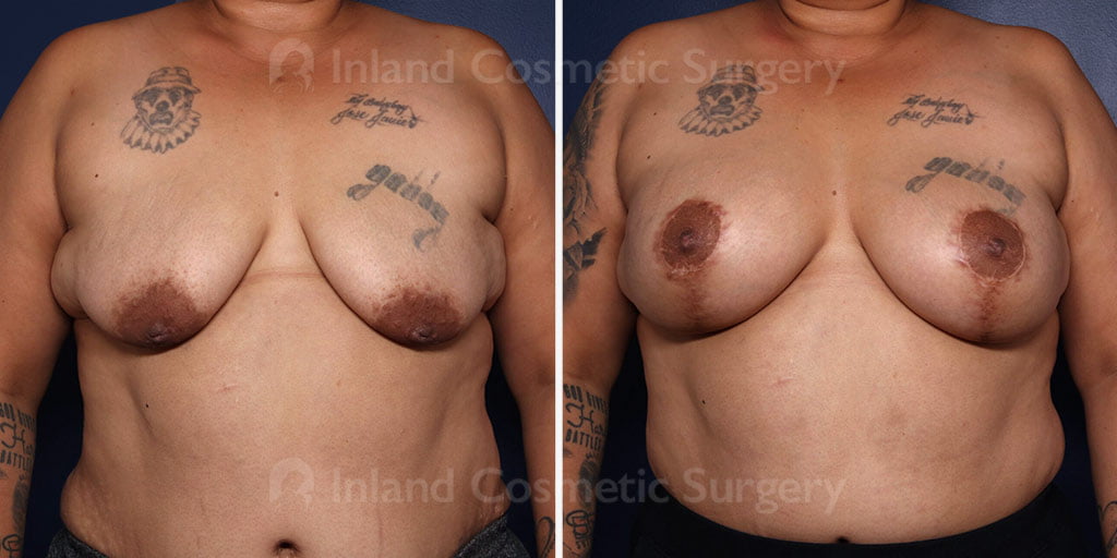 Breast Lift with Augmentation
