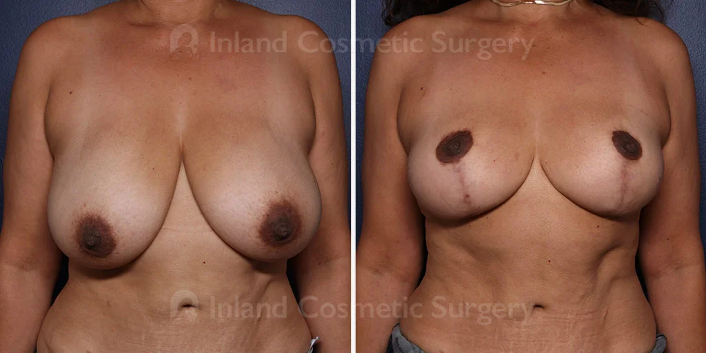 Breast Reduction