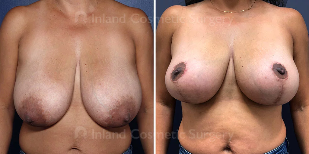 Breast Reduction with Lift