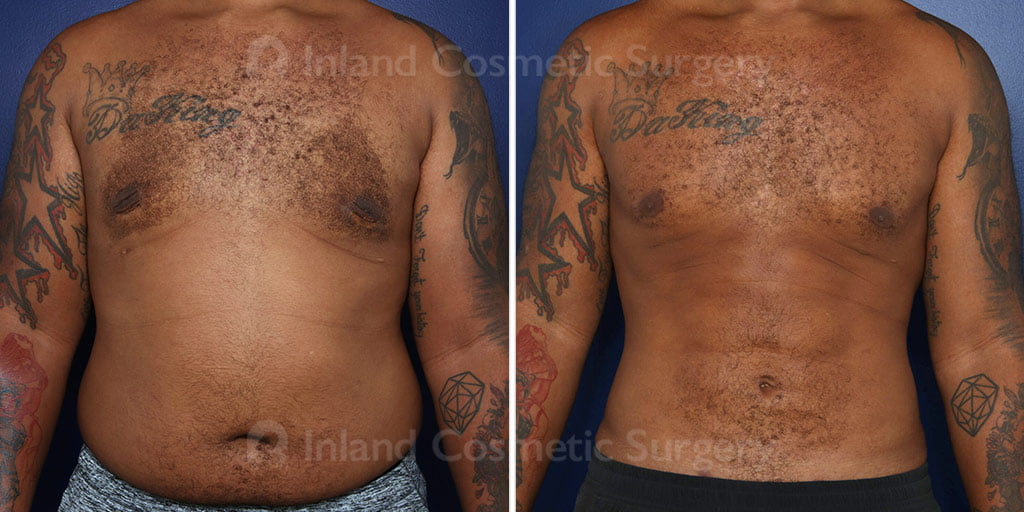 Male Breast Reduction