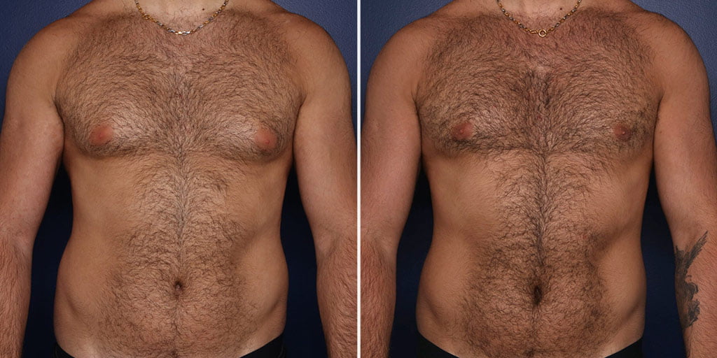 Male Breast Reduction