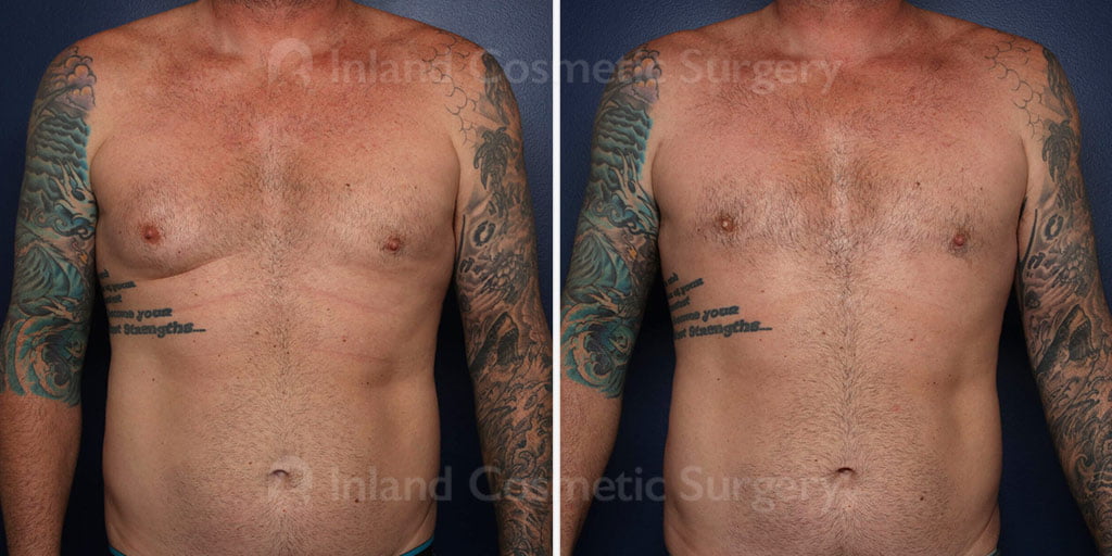 Male Breast Reduction