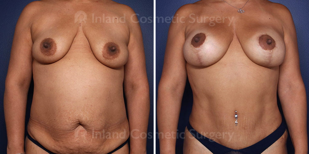 Breast Lift with Implants