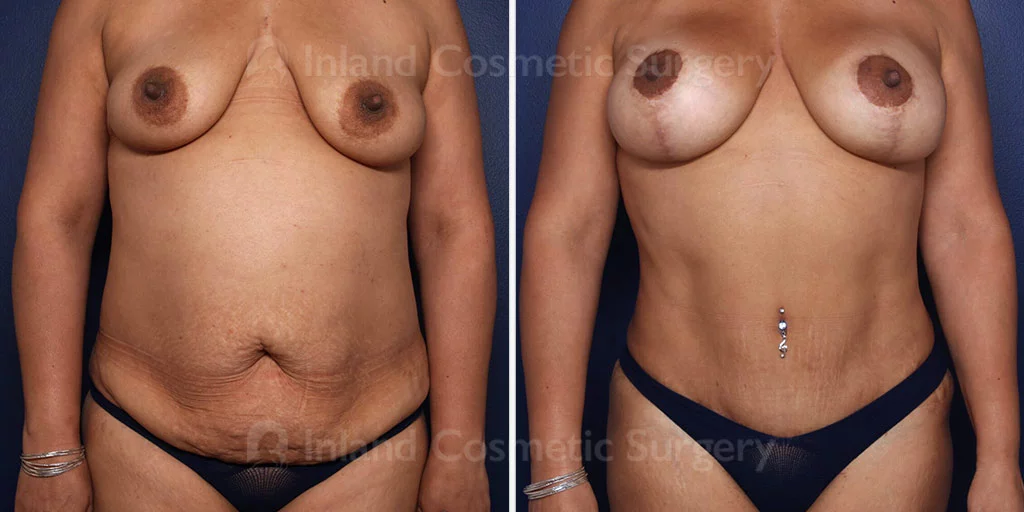 Tummy Tuck with Liposuction
