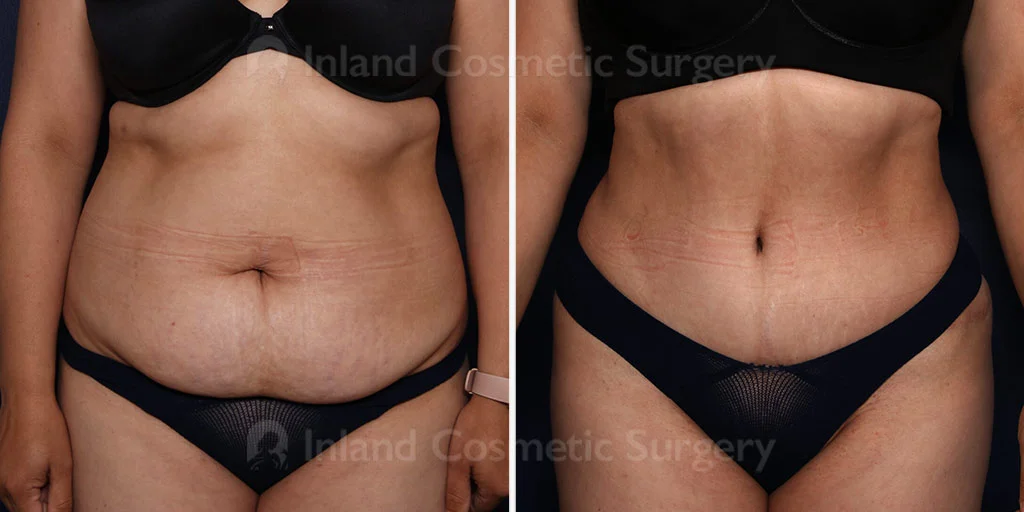 Tummy Tuck with Liposuction