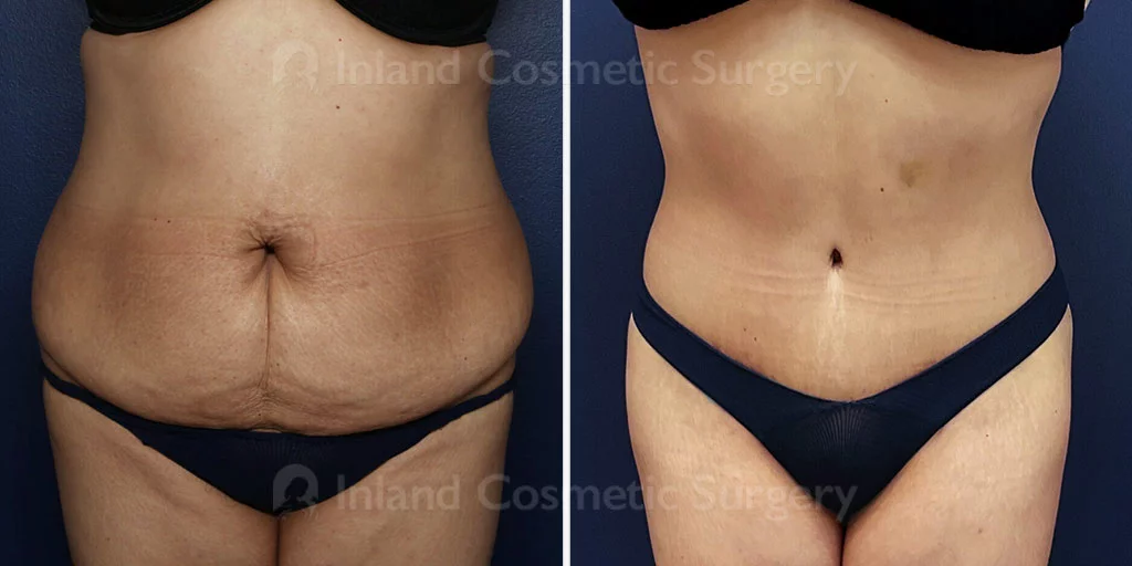 Tummy Tuck with Liposuction