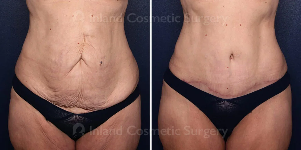 Tummy Tuck with Liposuction