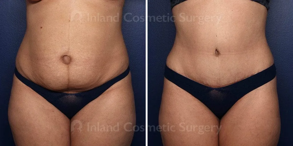 Tummy Tuck
