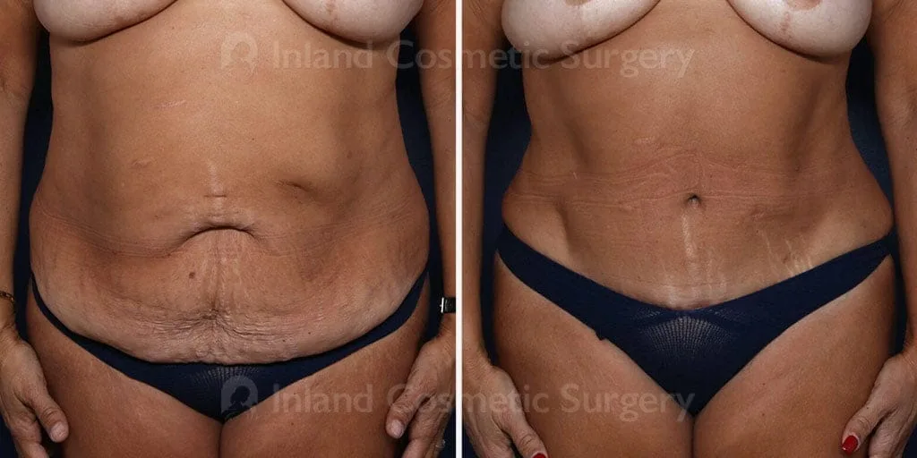 Tummy Tuck with Liposuction