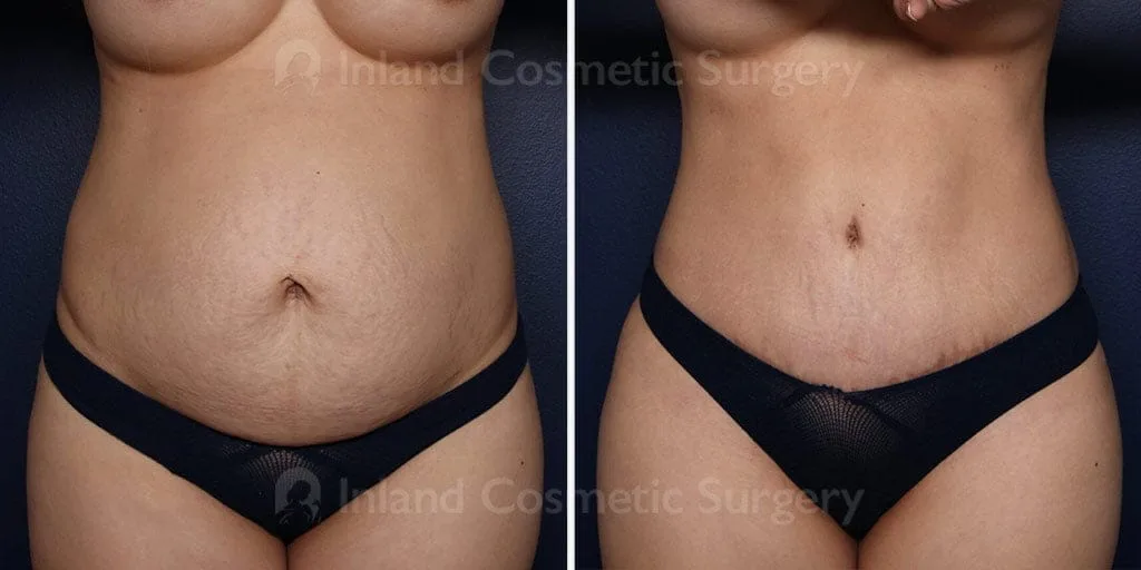 Tummy Tuck with Liposuction