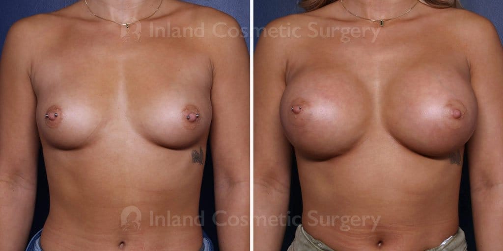 Breast Augmentation