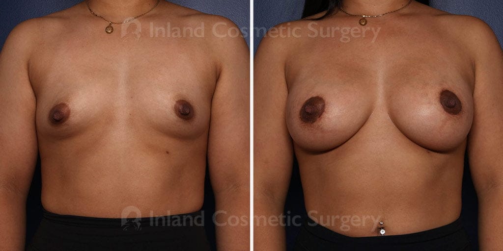 Breast Lift with Implants