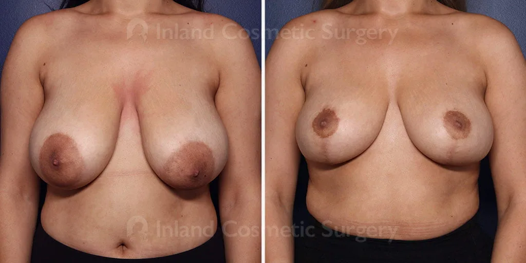 Breast Reduction with Lift