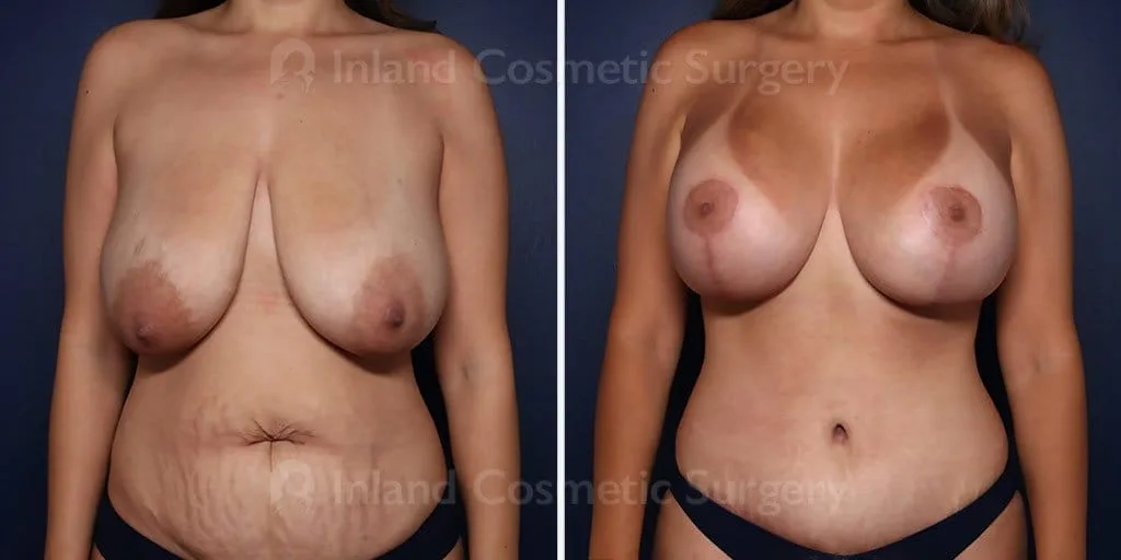 Breast Reduction/Lift with implants