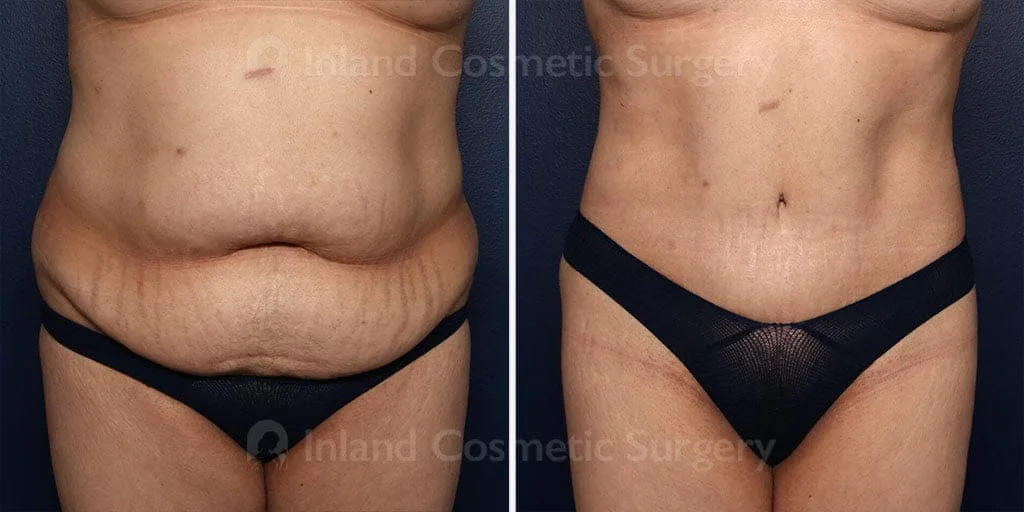 Tummy Tuck with Liposuction