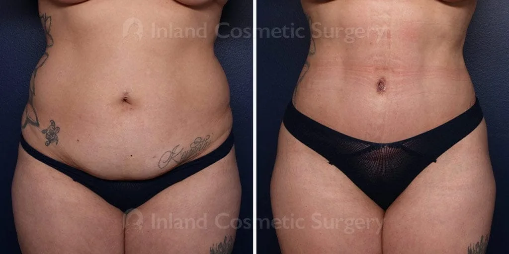 Tummy Tuck with Liposuction