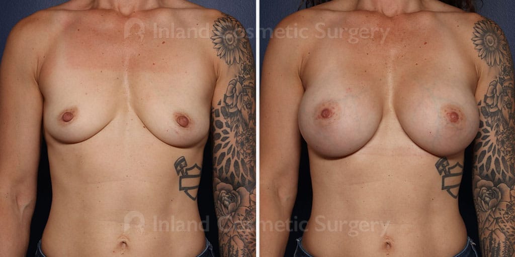 Breast Augmentation