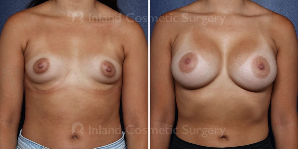 TUBA Breast Augmentation