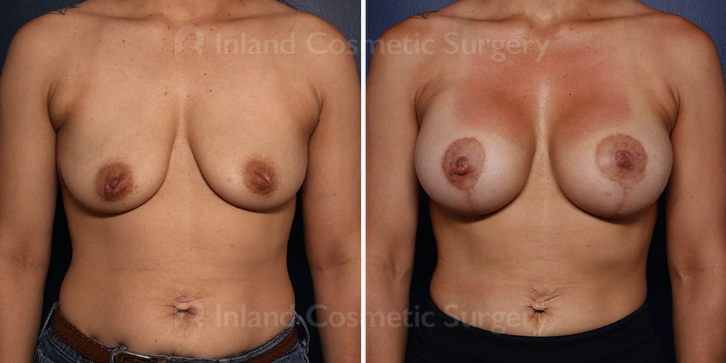 Breast Lift with Implants