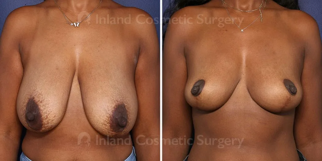 Breast Reduction/Lift