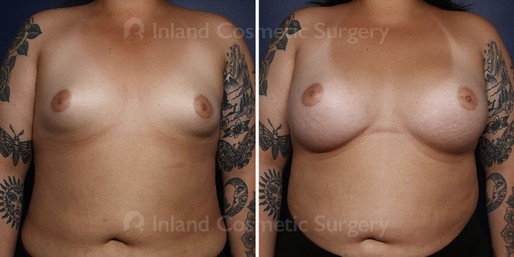 TUBA Breast Augmentation