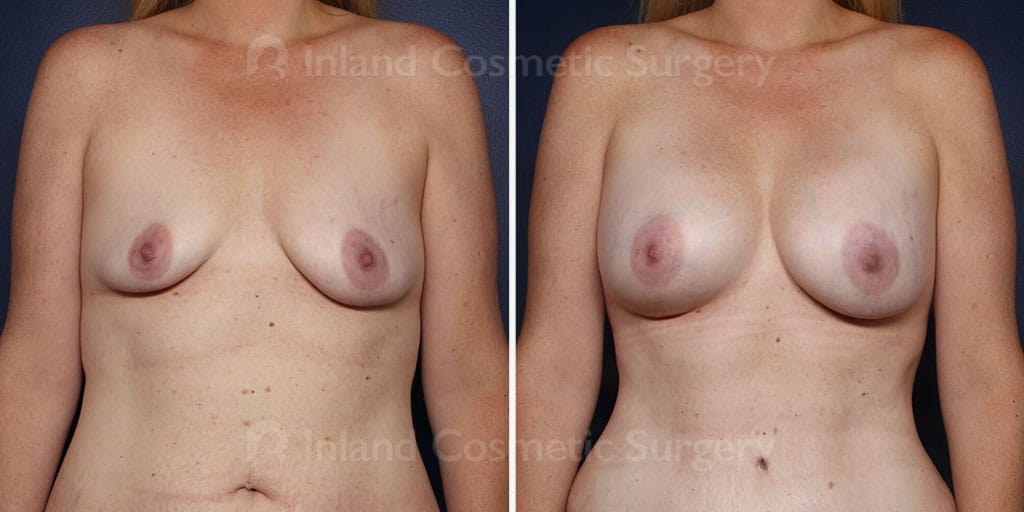 Breast Augmentation