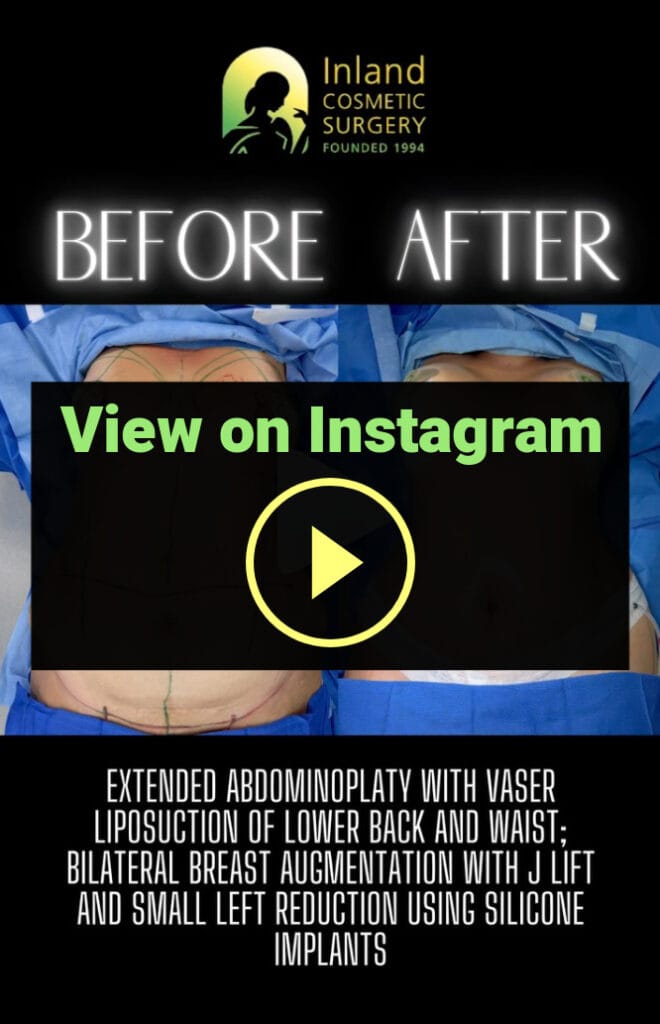 Breast Augmentation with a Lift and Mini-Reduction + Extended Tummy Tuck + VASER Lipo