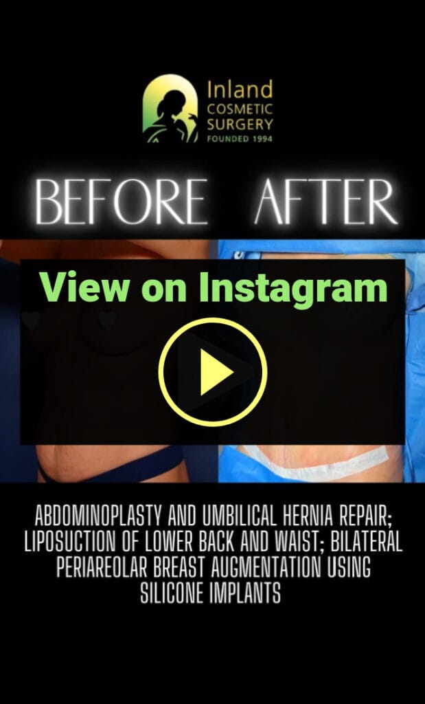 Breast Implants + Tummy Tuck + Liposuction of the Back and Waist