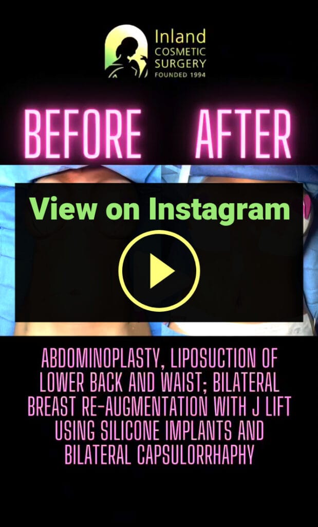 Breast Re-Augmentation & Lift + Tummy Tuck + a Little Liposuction at Inland Cosmetic Surgery