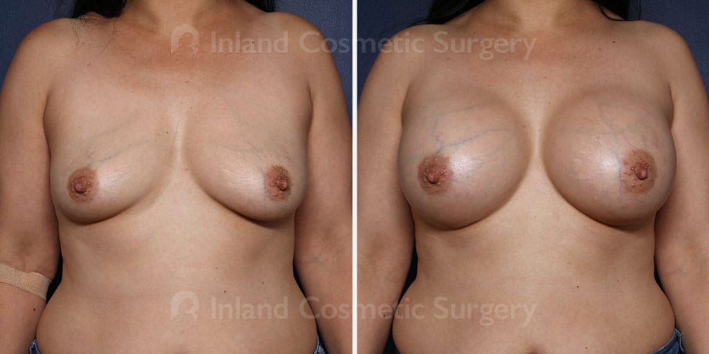Breast Augmentation