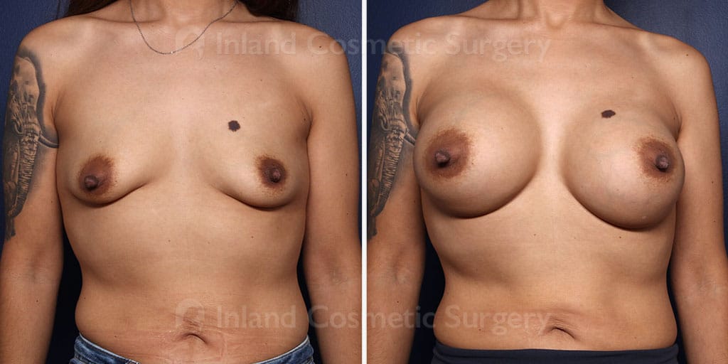 Breast Augmentation