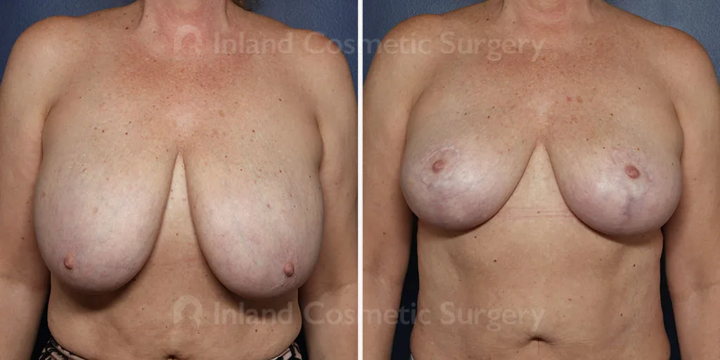 Breast Reduction/Lift
