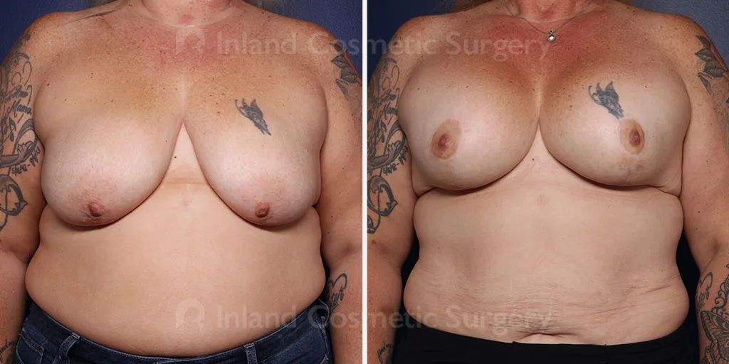 Breast Reduction with Lift and Implants