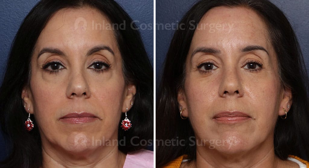 Eyelid Surgery