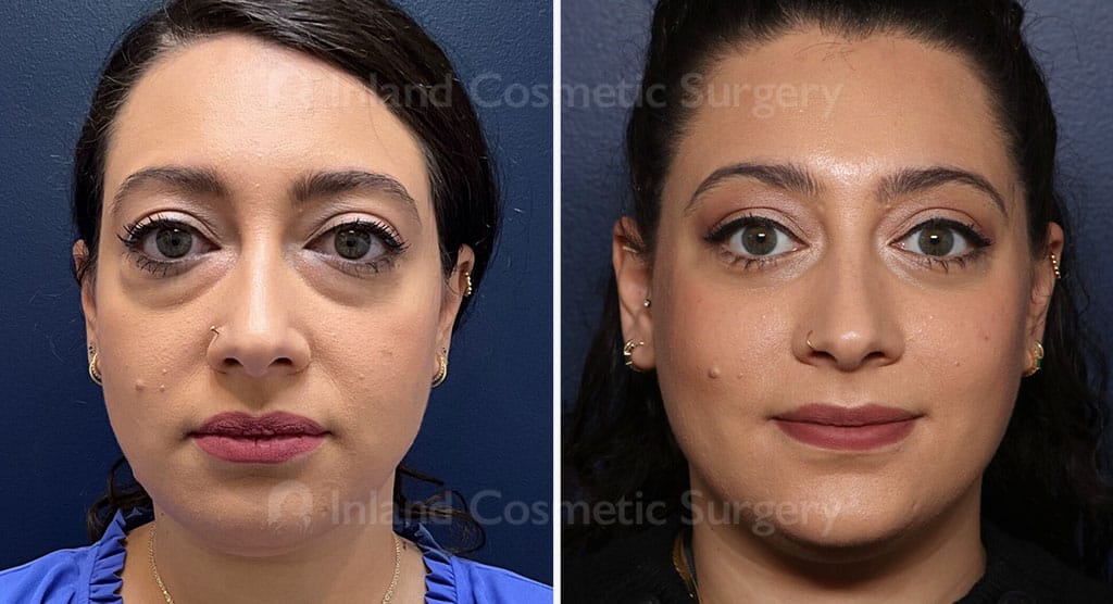 Eyelid Surgery