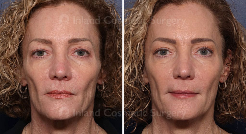 Eyelid Surgery