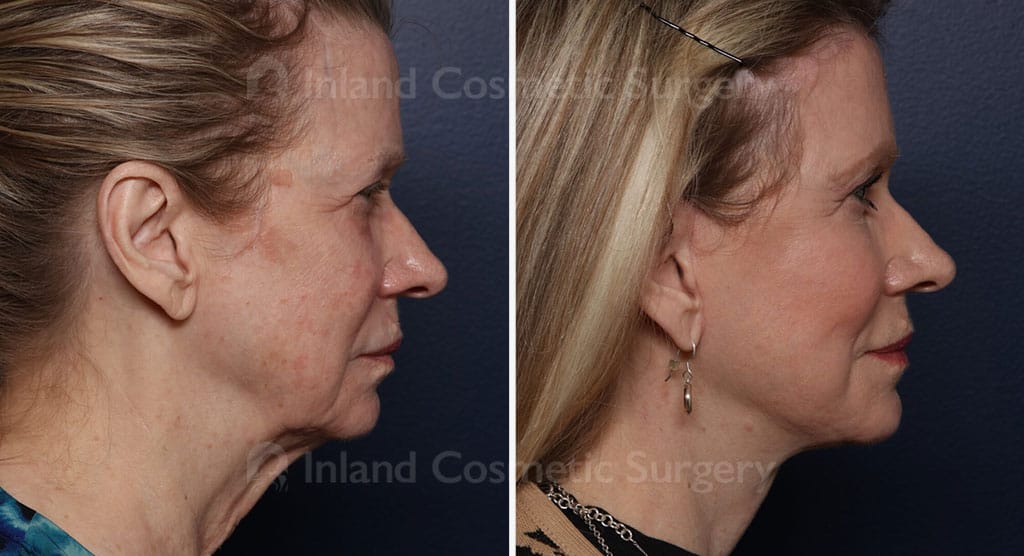 Face Multiple Procedures