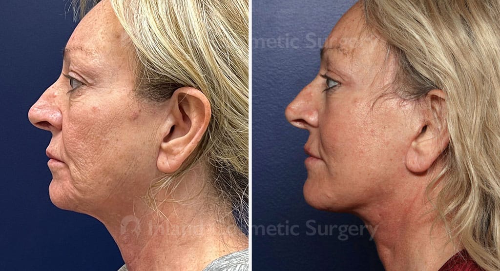 Face Lift, Neck Lift