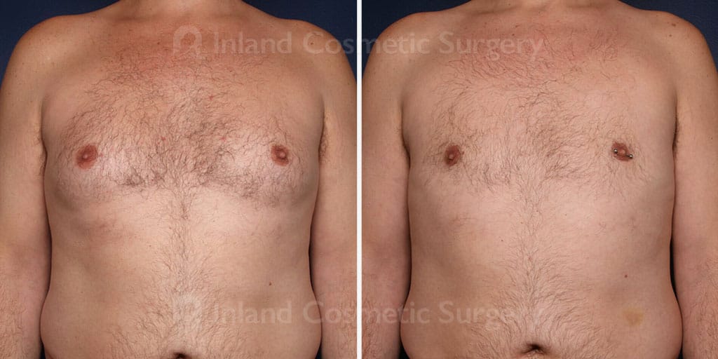 Male Breast Reduction