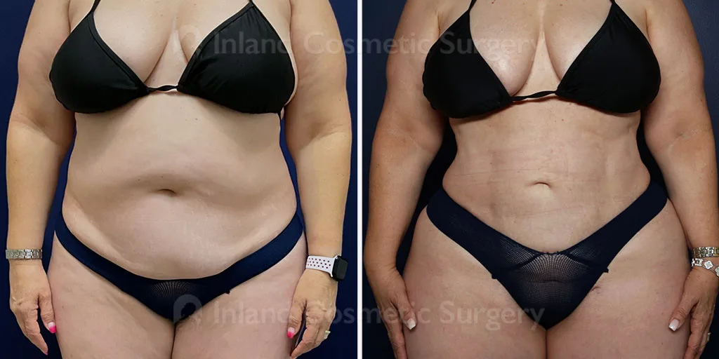 Liposuction